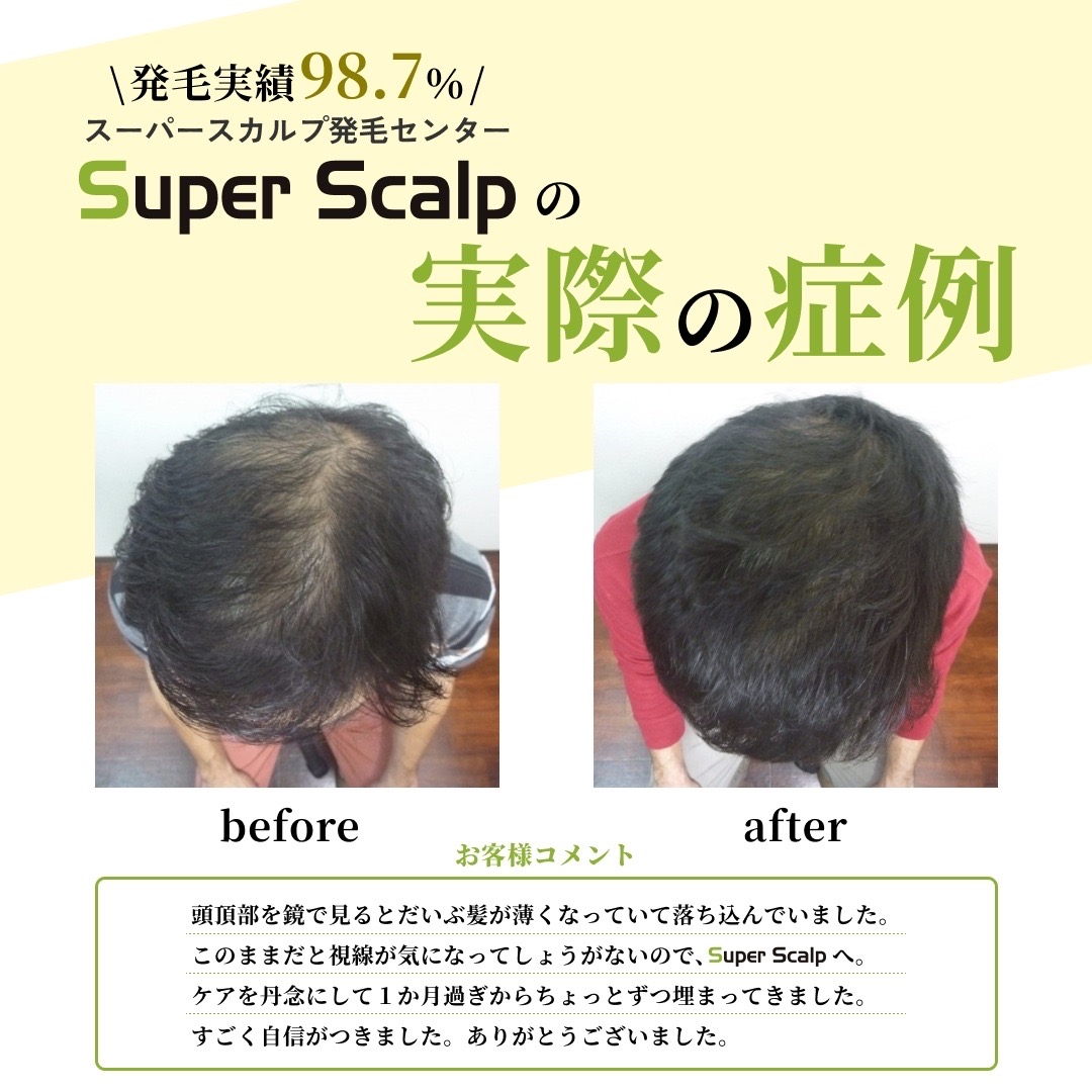 薄毛改善ビフォーアフター1