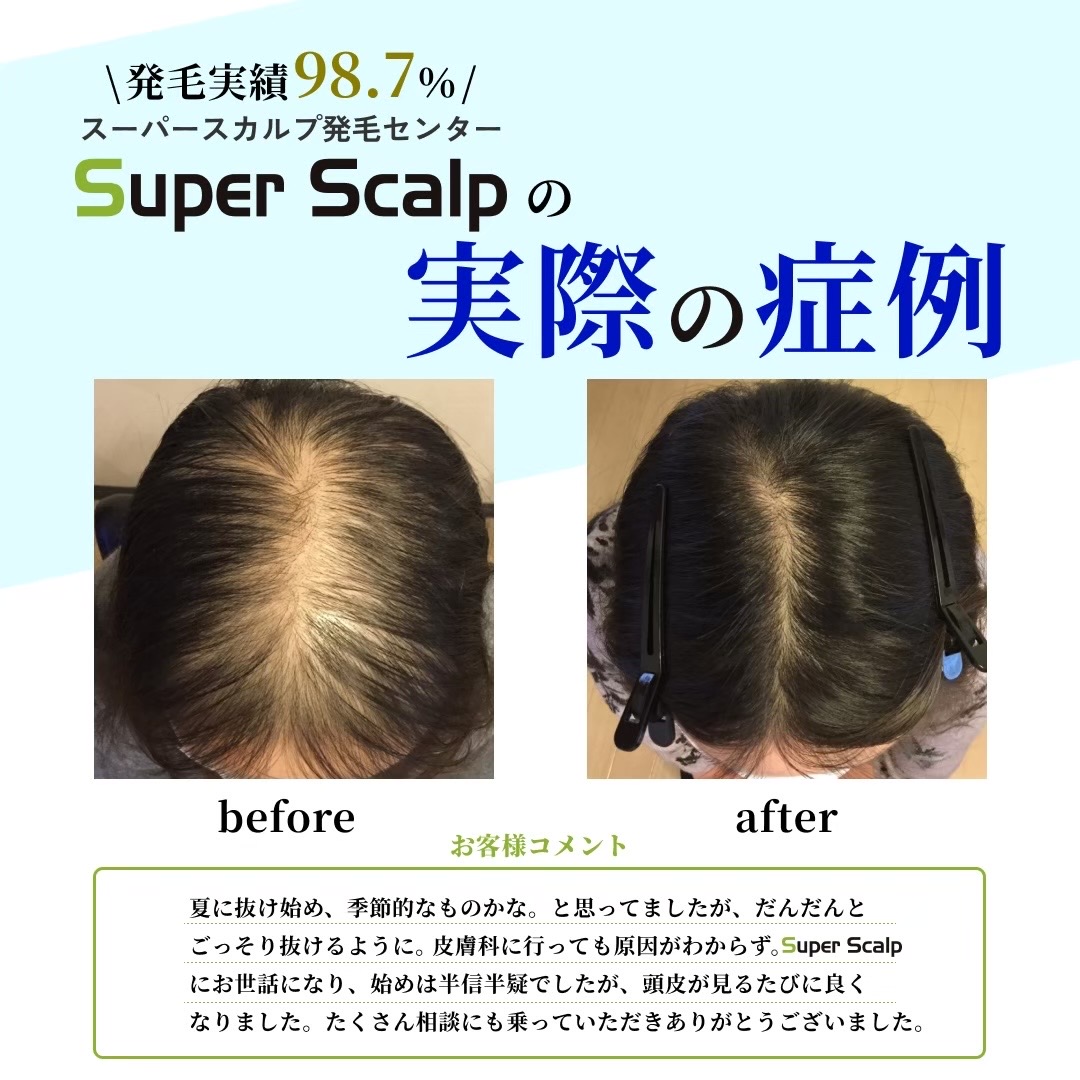 薄毛改善ビフォーアフター2